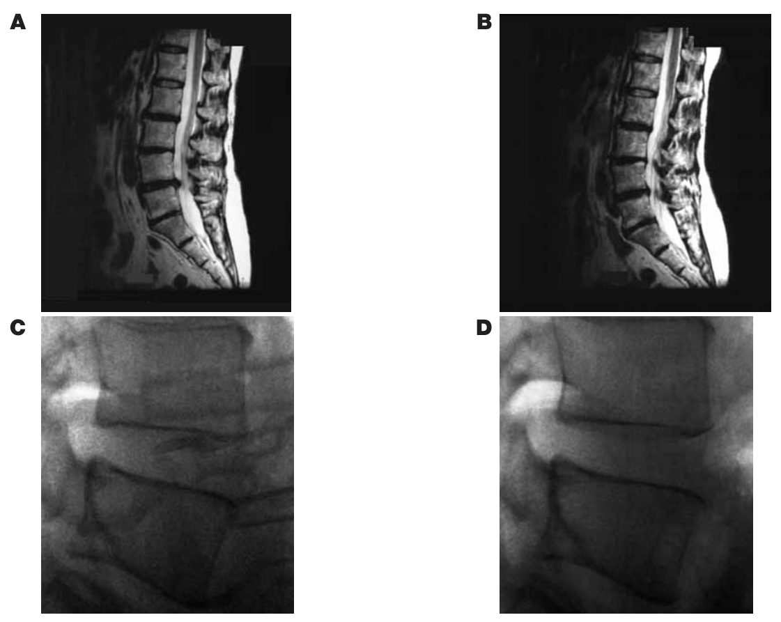 Panels A and B: lumbar MRI before and after treatment; panels C and D: lateral radiographs of a lumbar disk before and during treatment