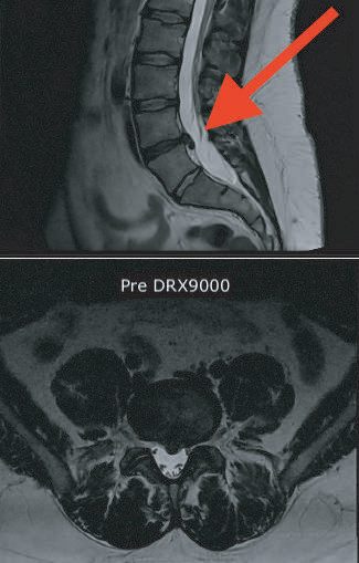 Lumbar spine MRI, sagittal and axial images labelled Pre DRX9000, with a red arrow