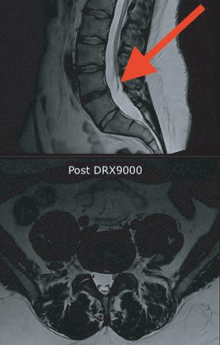 Lumbar spine MRI, sagittal and axial images labelled Post DRX9000, with a red arrow