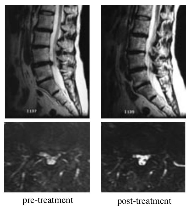 Case 1: lumbar MRI, sagittal and axial views, before and after treatment