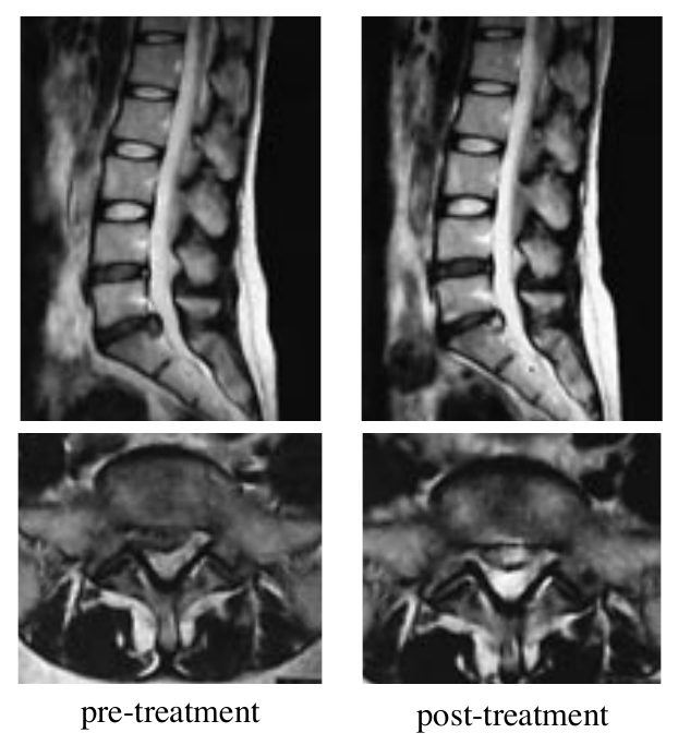 Case 2: lumbar MRI, sagittal and axial views, before and after treatment