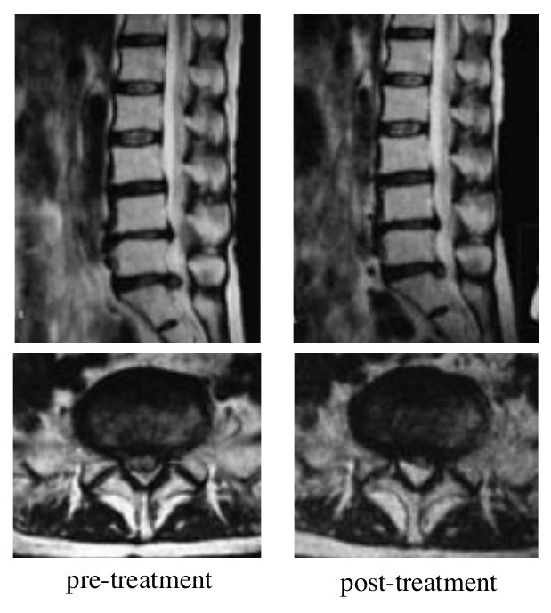 Case 3: lumbar MRI, sagittal and axial views, before and after treatment