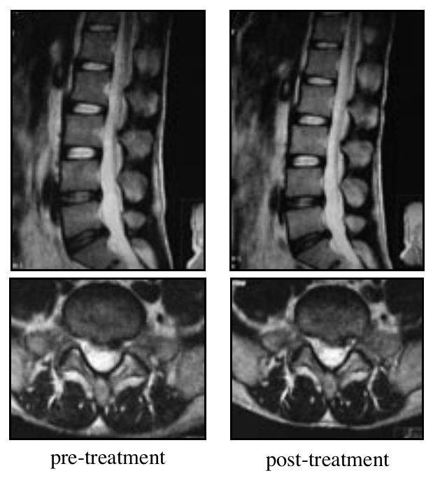 Case 4: lumbar MRI, sagittal and axial views, before and after treatment
