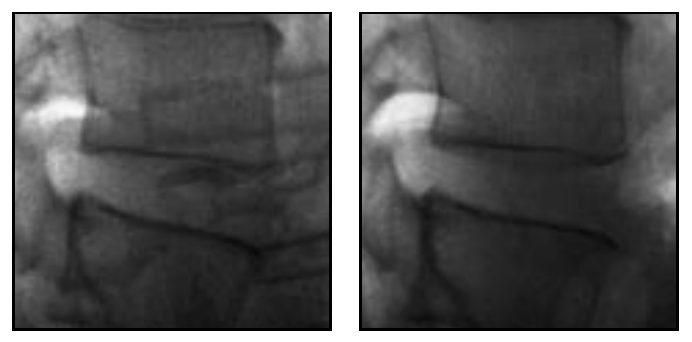 Healthy person 1: two lateral radiographs of the lumbar disc space, side by side