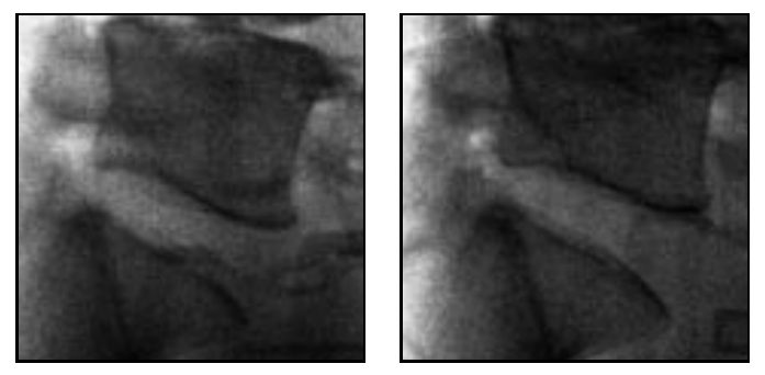 Healthy person 2: two lateral radiographs of the lumbar disc space, side by side