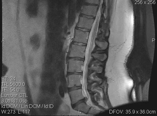 Pre-treatment sagittal MRI of the lumbar spine